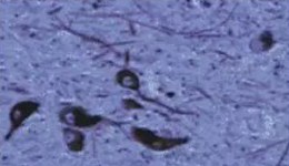 正凡人：：黑质神经元保存