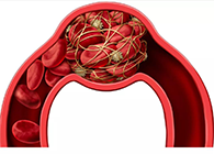 令人“闻风丧胆”的脑卒中发明治疗新机制！