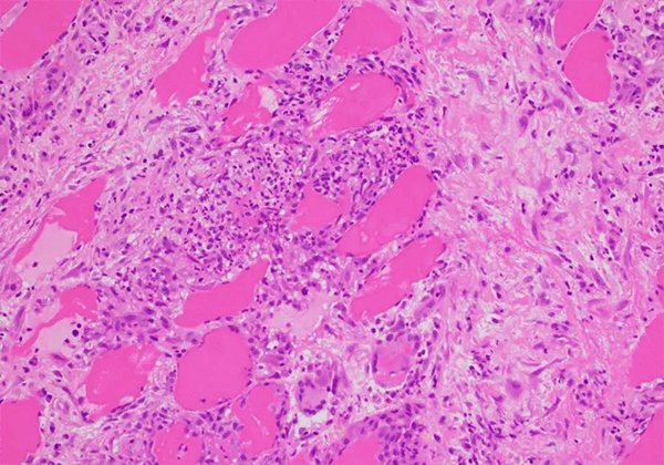 【Ladbrokes立博助力】治疗结节病的KBMAB-16获FDA批准临床